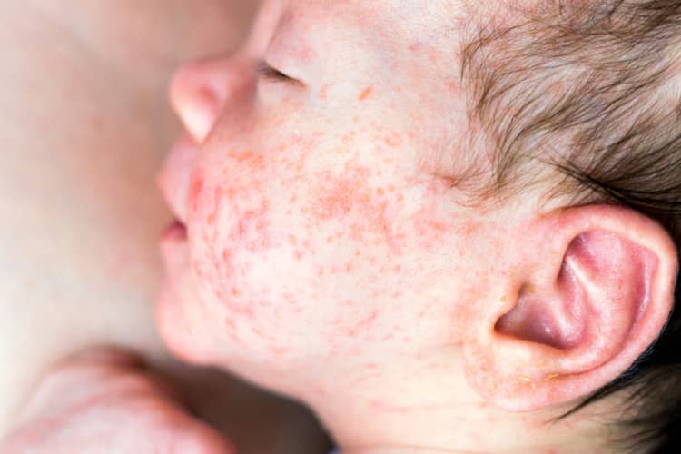 What does newborn acne look like?