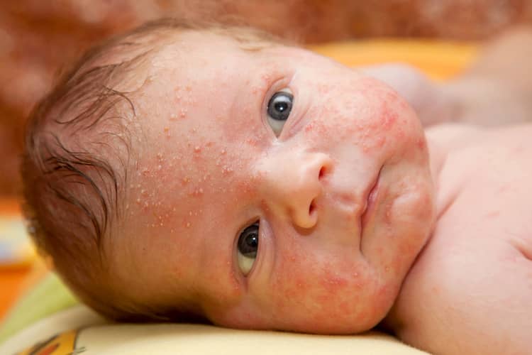 What is newborn acne?