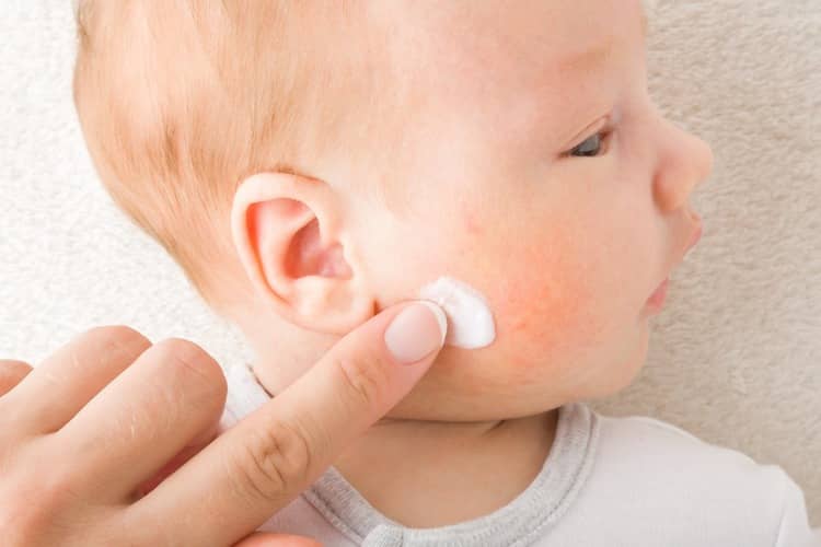 Cream for newborn acne