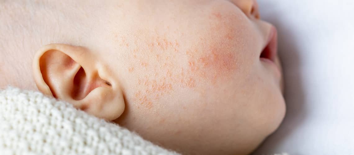 Newborn acne