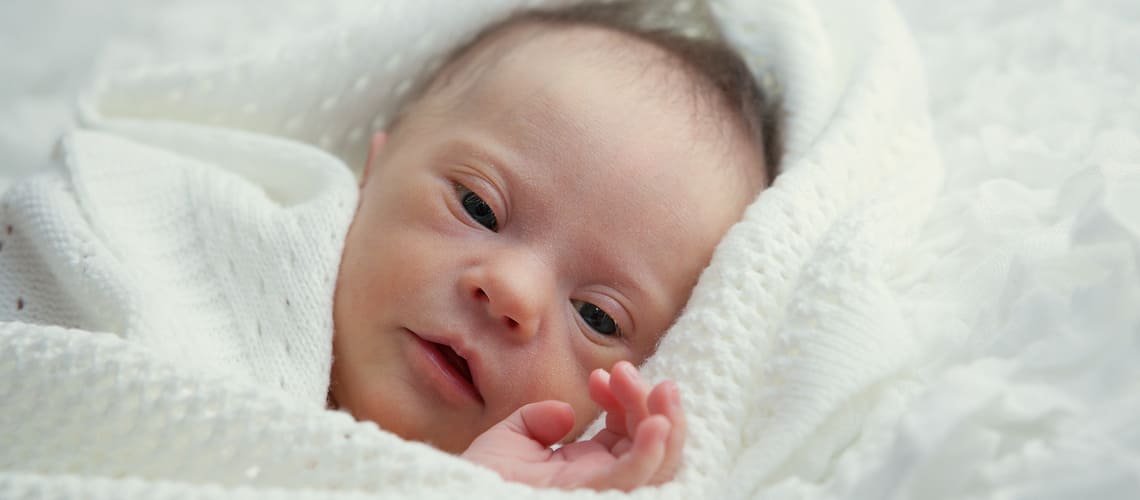 What are the symptoms of Down syndrome in a newborn?