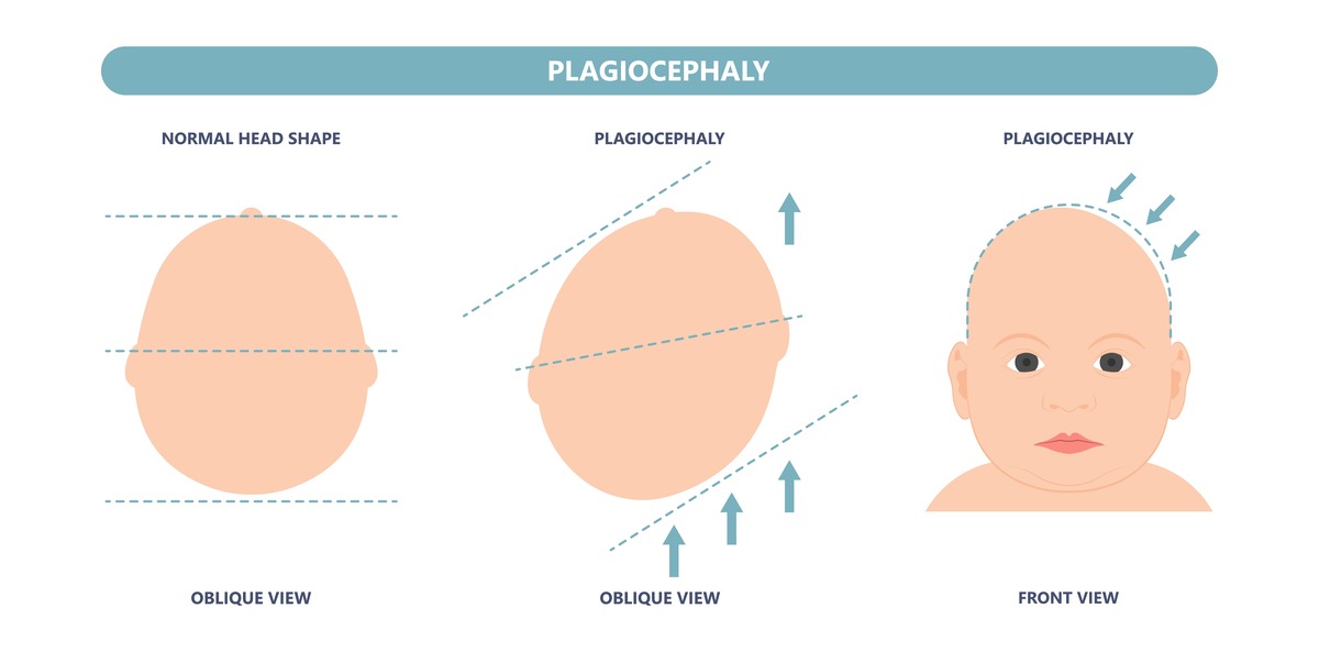 Plagiocephaly