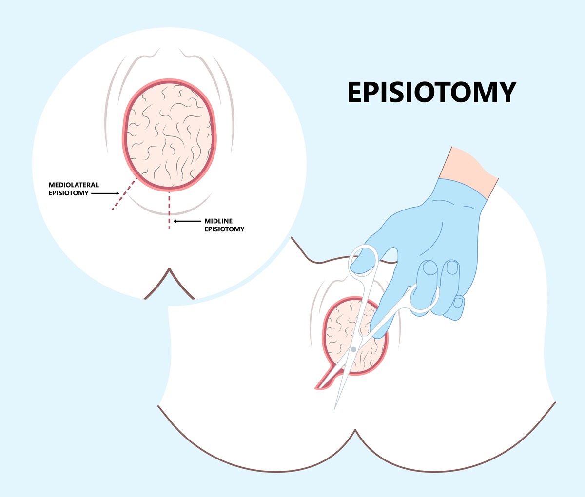 Incision of the perineum - episiotomy