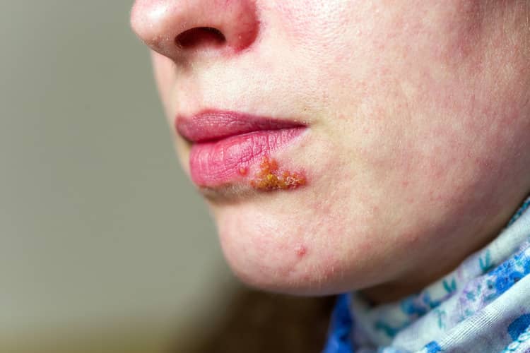 Herpes on the lips during pregnancy