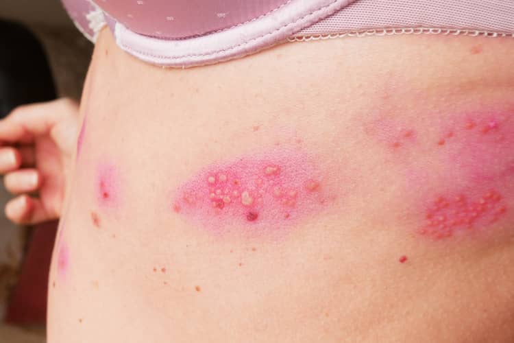 Shingles in pregnancy