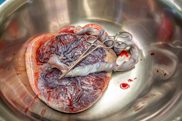 Placenta with umbilical cord