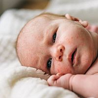 Newborn acne on the face