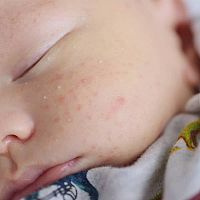 Newborn acne symptoms