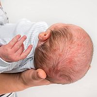 Newborn acne in the hair