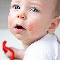 Newborn acne treatment