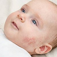 Newborn acne on the cheeks