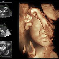 3D ultrasound