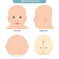 Brachycephaly