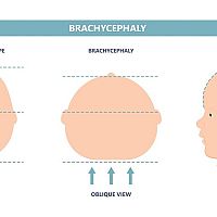 Flat head brachycephaly