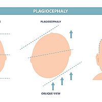 Plagiocephaly