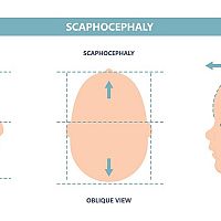 Scaphocephaly