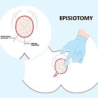 Episiotomy