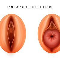 Prolapse of the Uterus