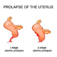 What does a prolapsed uterus look like?