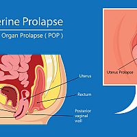 Uterine prolapse