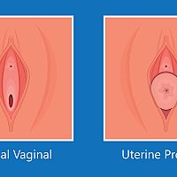 Normal vaginal / Uterine prolapse