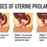 Stages of uterine prolapse