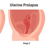 What does a prolapsed uterus look like?