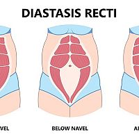 Diastasis recti types