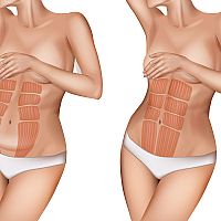 Diastasis Recti versus Normal Abdomen