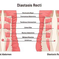 Diastasis Recti