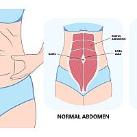 Normal abdomen / Diastasis Recti