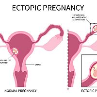 Ectopic pregnancy causes