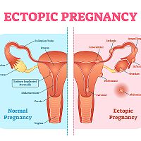 Normal and ectopic pregnancy