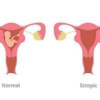 Normal versus ectopic pregnancy