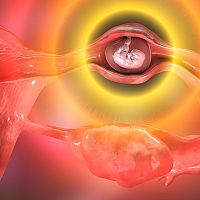 Occurrence of ectopic pregnancy