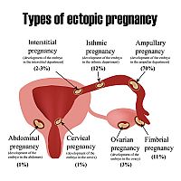 Types of ectopic pregnancy