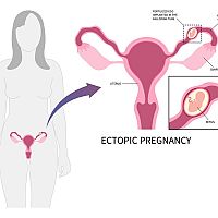 Ectopic pregnancy